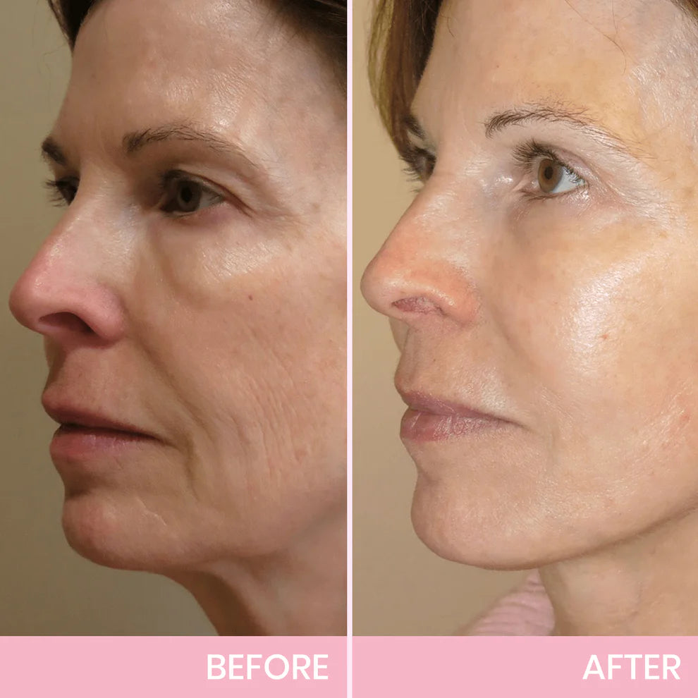 OUHOE V-Face Lifting Invisible Adhesive Tape
