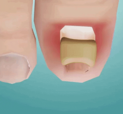 Nail Care Correction Patches