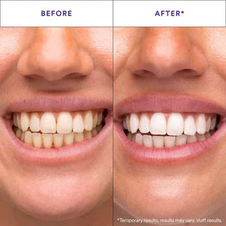 Teeth Whitening Stripes