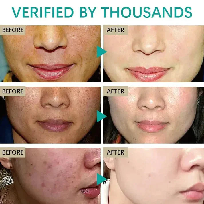 Crema blanqueadora de piel correctora de manchas oscuras 